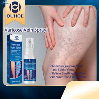Crema para piernas con varices - Dolor venas varicosas tratamiento –