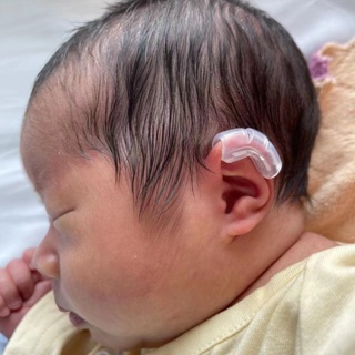 Corrector estético de oreja de bebé, corrección de orejas